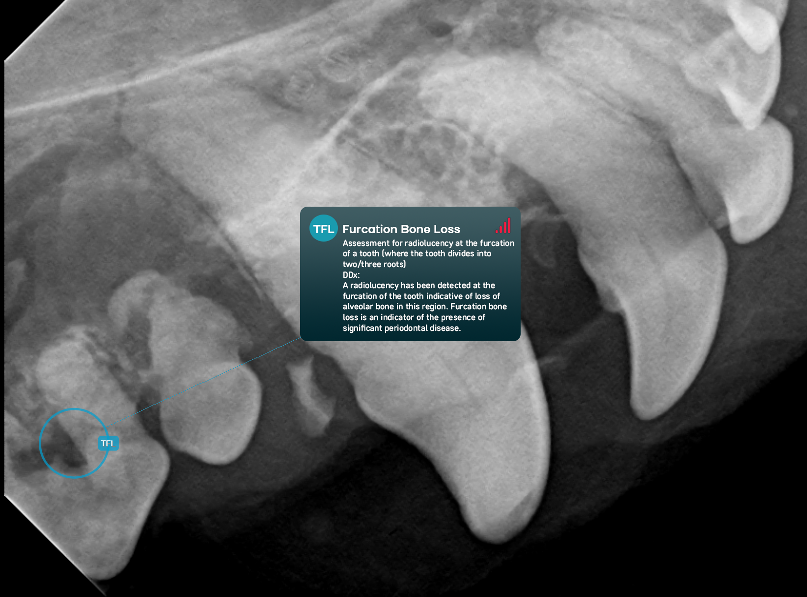 Furcation Bone Loss