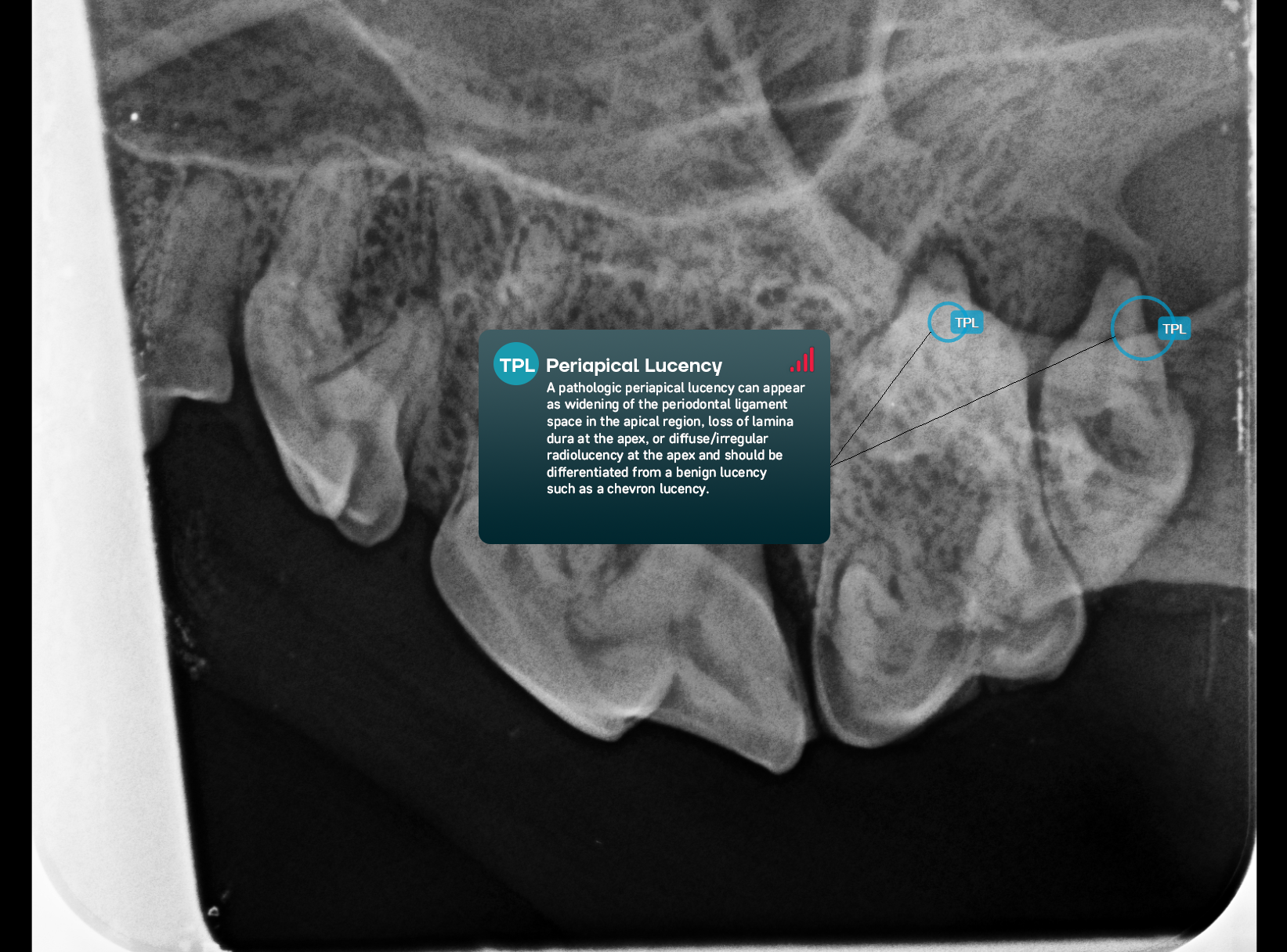 Periapical Lucency-1