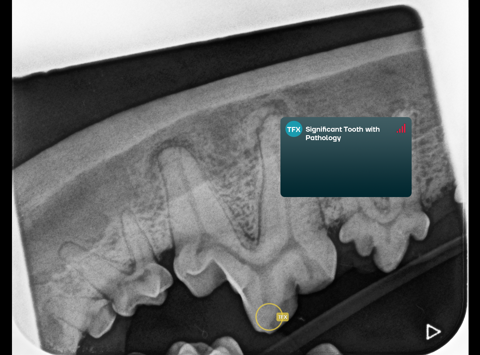 Significant Tooth with Pathology